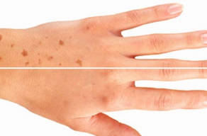 Be.U Hands Premium (hifu com exossomas para mãos)