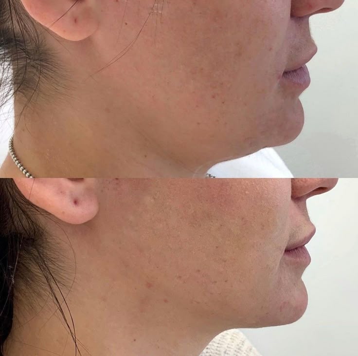 Be.U HIFU LOCALIZADO para Terço Inferior (papada e pescoço)