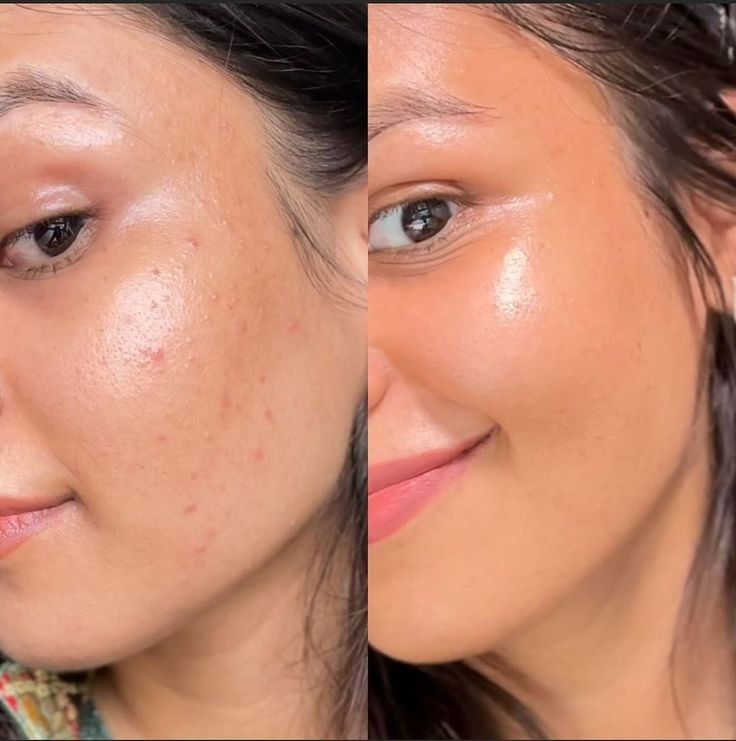 Be.U 4Acne (tratamento de peeling químico para acne)