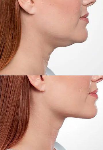 Be.U HIFU LOCALIZADO para Terço Inferior (papada e pescoço)