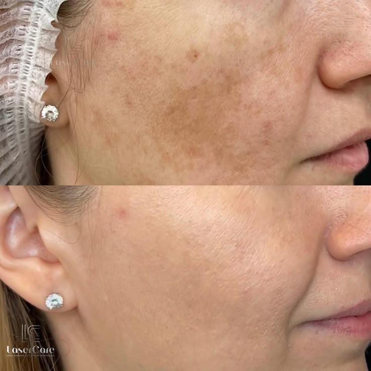 Be.U Spots (tratamento de peeling químico para manchas)