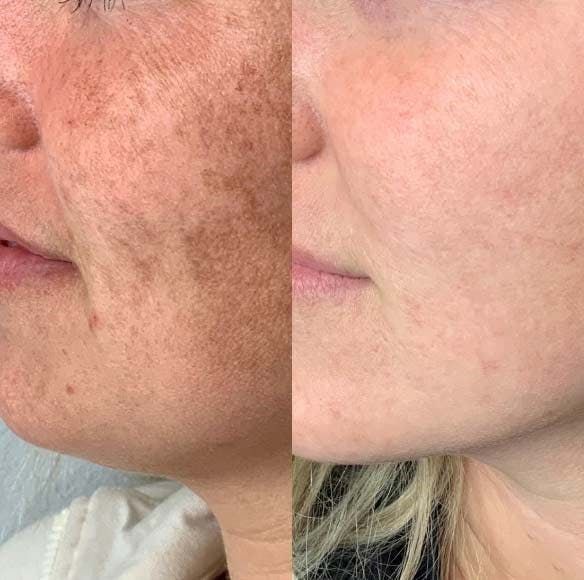 Be.U Spots (tratamento de peeling químico para manchas)