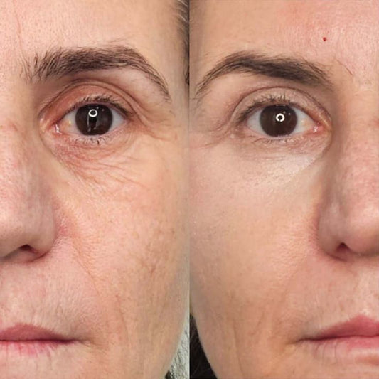 BeU LumiPeel (peeling químico rosto completo)