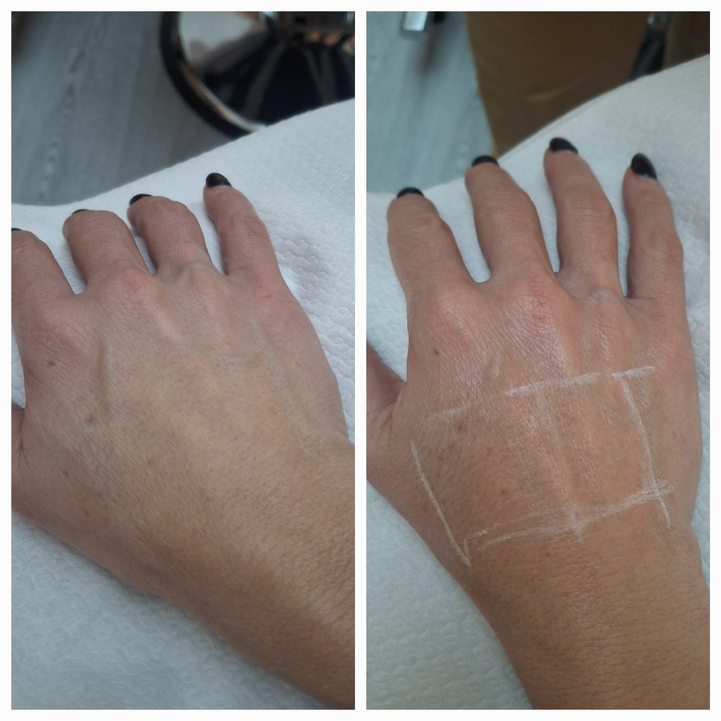 Be.U Xpress- Hidratação com ácido hialurónico (Pés de galinha, bigode chinês, terço superior, terço médio, terço inferior, colo e mãos)