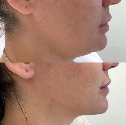 Be.U HIFU LOCALIZADO  para Terço Inferior (papada e pescoço)