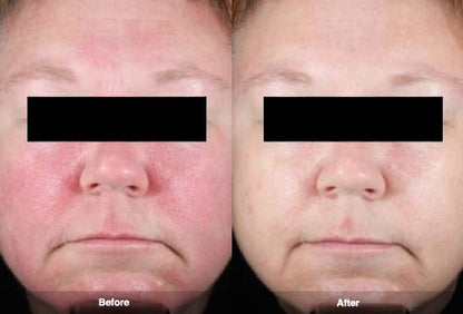 BeU Red Relief (tratamento de peeling químico para pele sensivel ou rosácea)