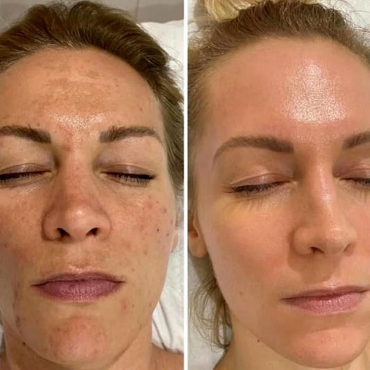 Be.U 4Acne (tratamento de peeling químico para acne)