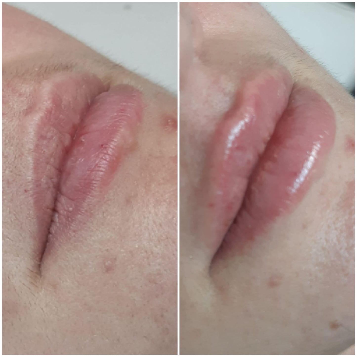 BeU Hialurónico Booster Lips- redifinição e hidratação labial com ácido hialurónico