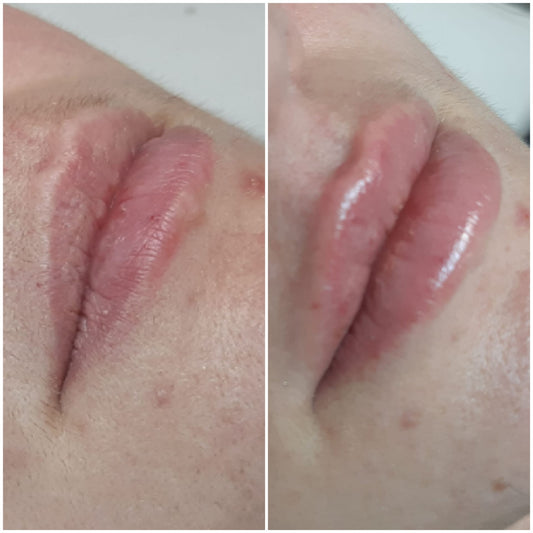 BeU Hialurónico Booster Lips- redifinição e hidratação labial com ácido hialurónico