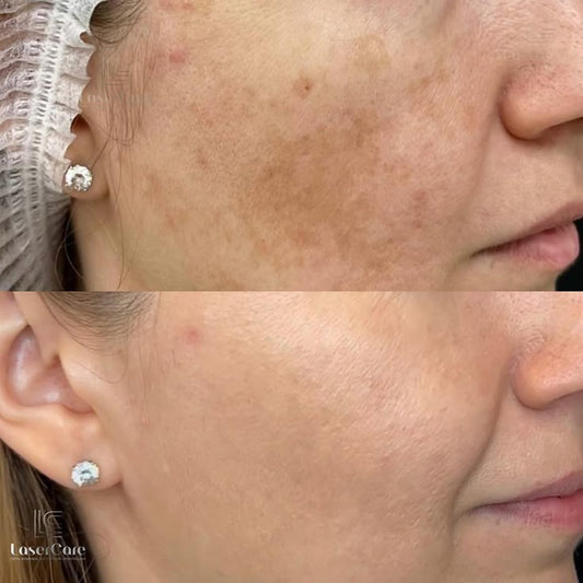Be.U Spots (tratamento de peeling químico para manchas)