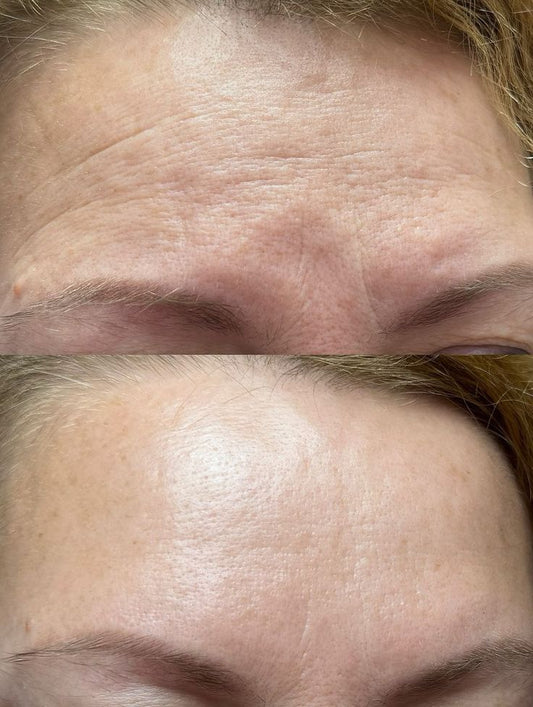Be.U Anti-Ageing (tratamento de peeling químico anti idade)