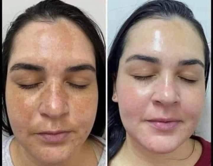 BeU Red Relief (tratamento de peeling químico para pele sensivel ou rosácea)